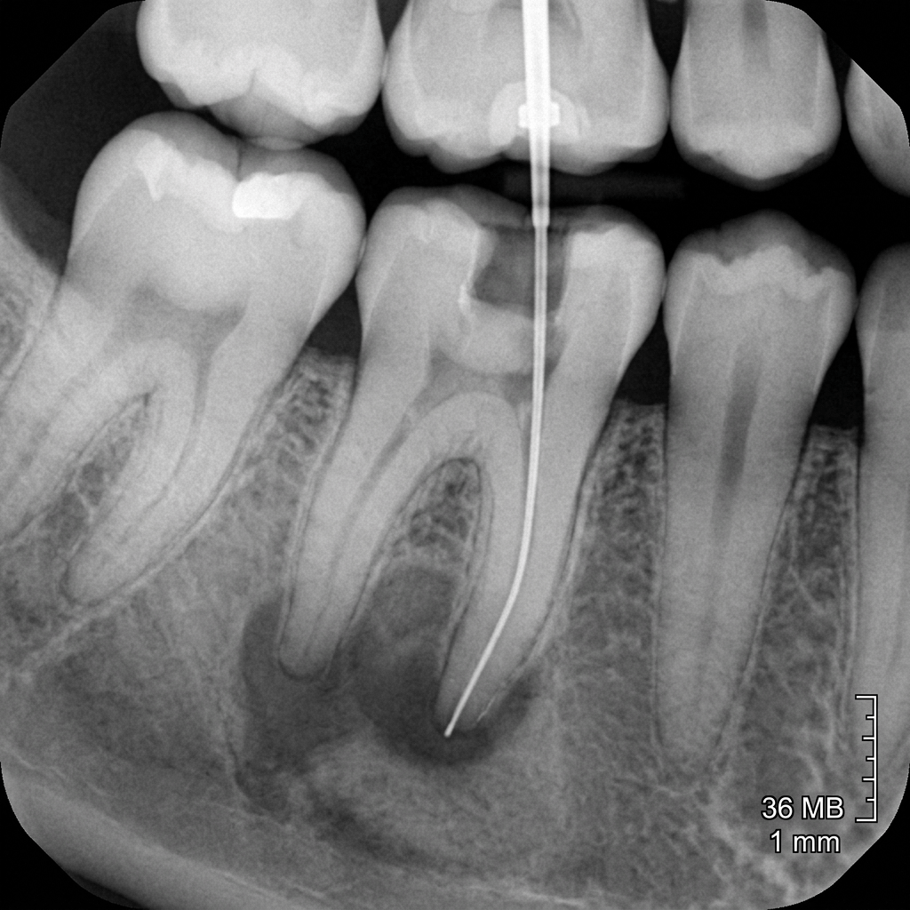 Dental X-ray showing a root canal file in a lower tooth