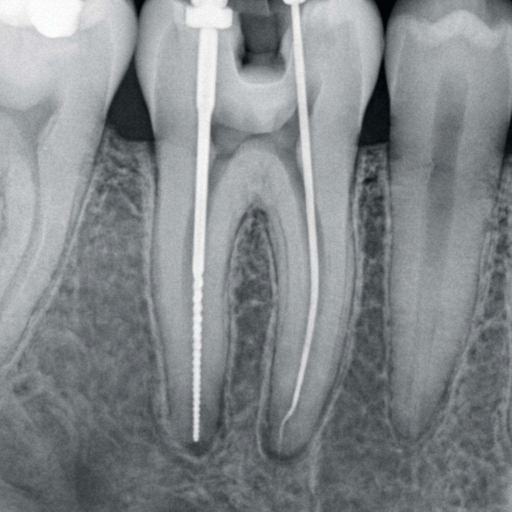 Annotated left ankle X-rays showing tibia, fibula, talus, and fractures